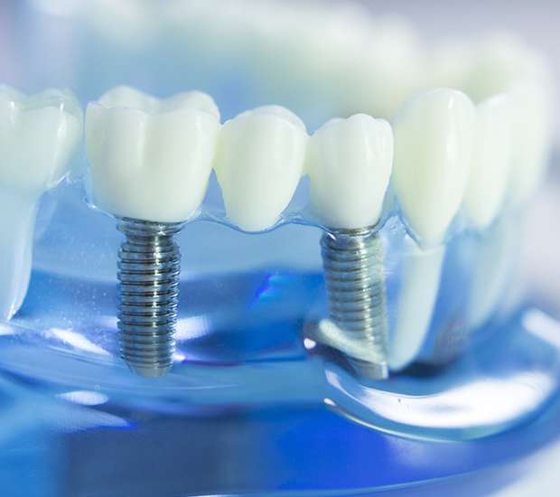 Great Neck Dental Implants